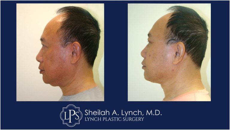 Male Neck lift Patient Before and After Pictures, Vertical Face Surgeon Washington DC.