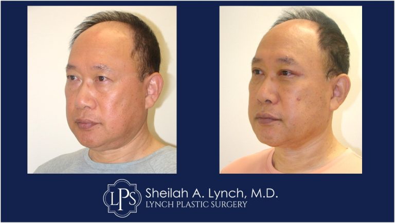Male Vertical Facelift Patient - Vertical Washington DC Facelift Surgeon Sheilah Lynch, MD
