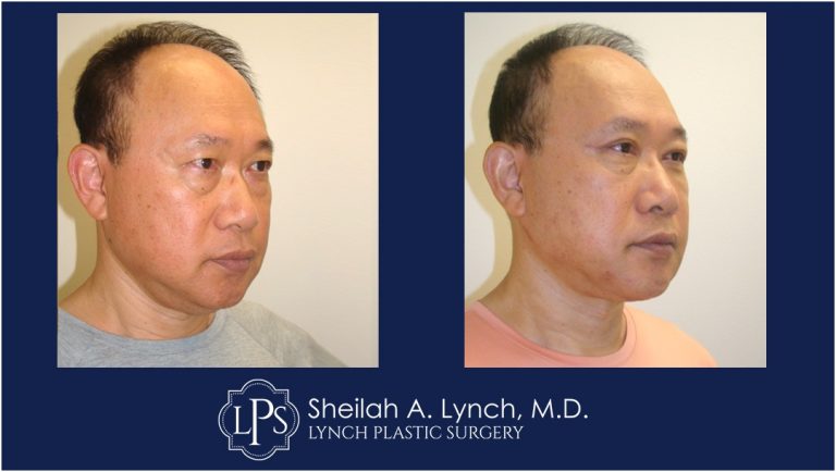 Male Vertical Facelift Patient - Vertical Facelift Surgeon Maryland Sheilah Lynch, MD