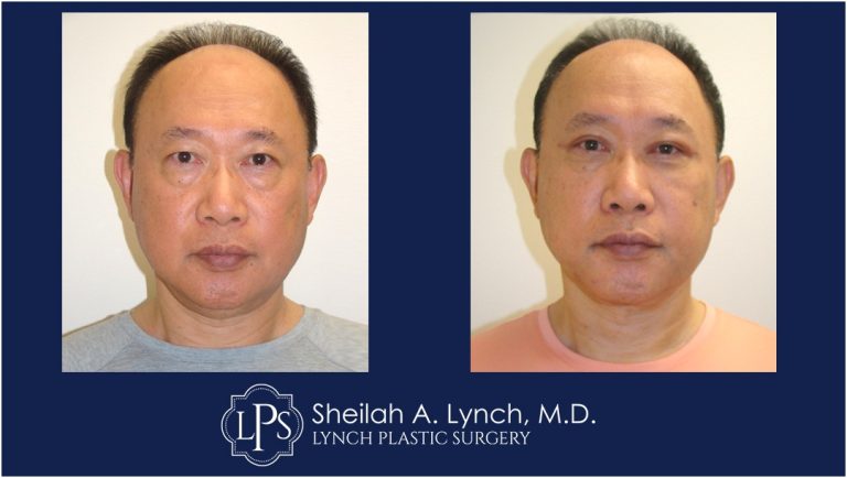 Male Vertical Facelift Patient - Vertical Facelift Surgeon In Maryland