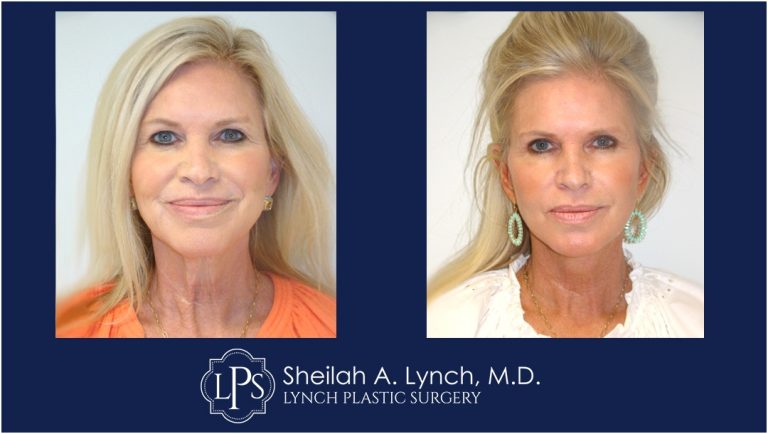 Vertical Facelift Patients Before After Images Washington DC Facelift Surgeon Sheilah Lynch, MD