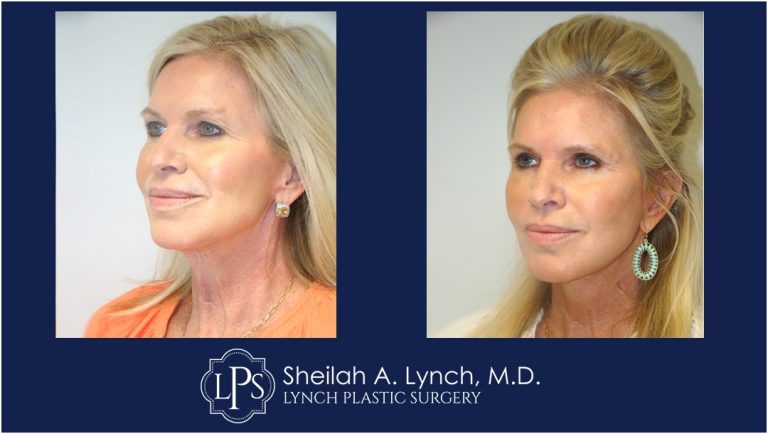 Vertical Facelift Patient 1 Before After Images Washington DC Facelift Surgeon Sheilah Lynch, MD