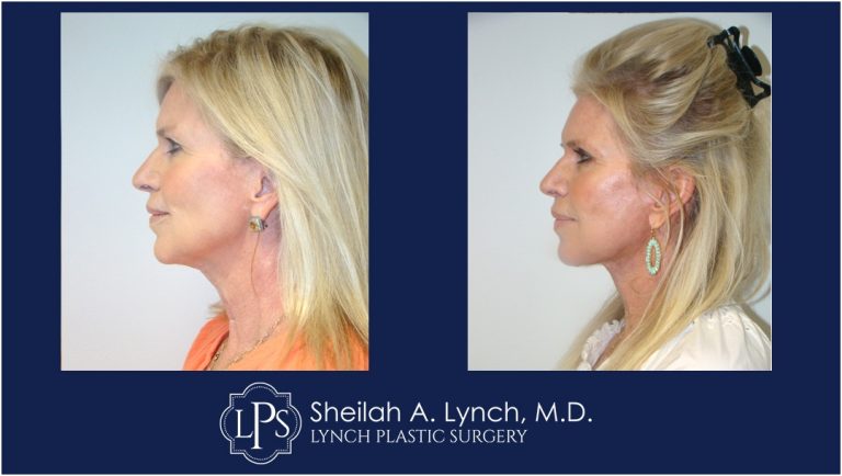 Before and After Pictures, Vertical Face Surgeon Washington DC. Vertical Facelift Surgeon Washington DC Sheilah Lynch, MD