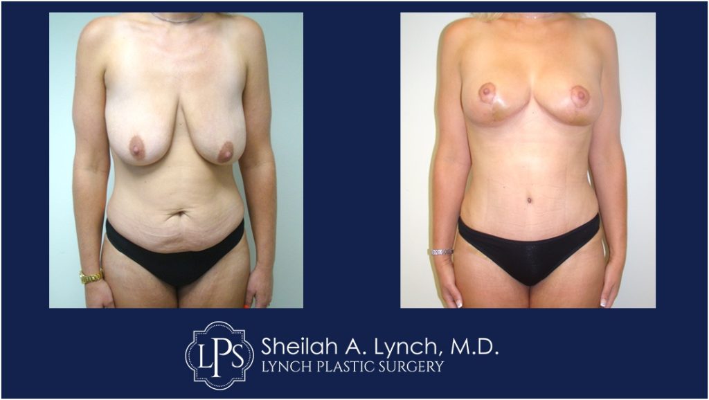 Breast Reduction Patient 5 Before and After
