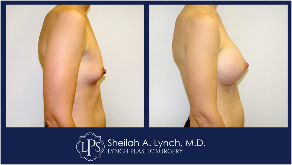 Breast Lift patient 12 before and after images