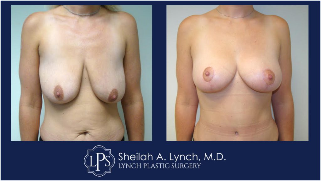 Easton Breast Lift Before and After patient 9