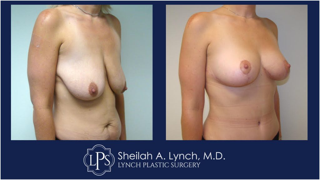 Easton Breast Lift Before and After patient 9