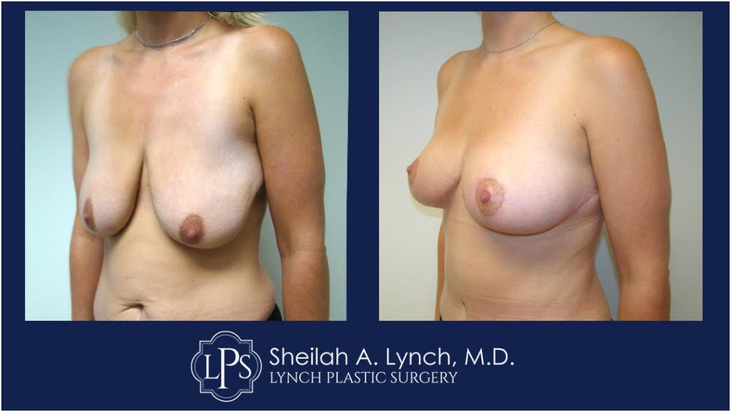 Easton Breast Lift Before and After patient 9