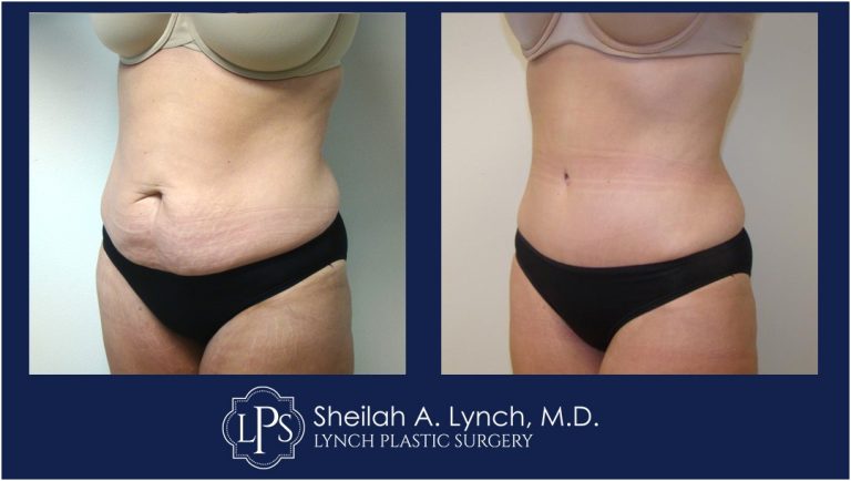 Tummy Tuck Patient 19 Before After