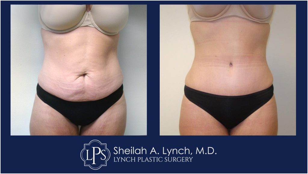 Tummy Tuck Patient 19 Before After