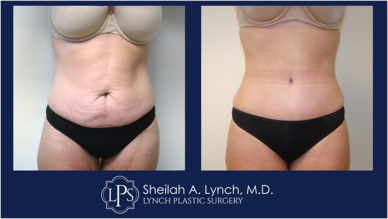 Tummy Tuck Patient 19 Before After