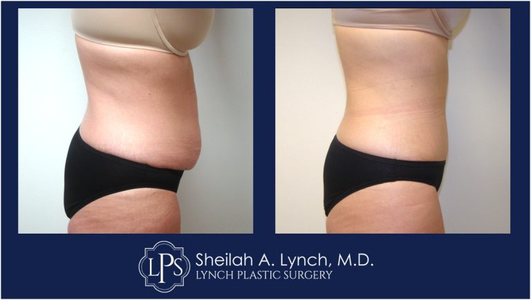 Tummy Tuck Patient 19 Before After