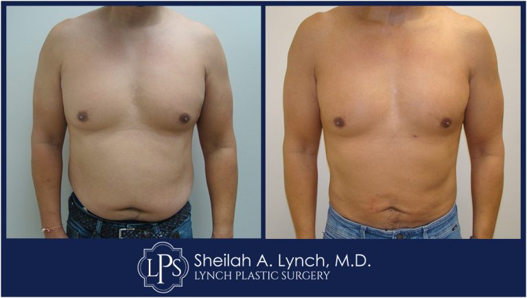 Male Lipo 360 Before and After Images In Easton, Chevy Chase, Washington DC.