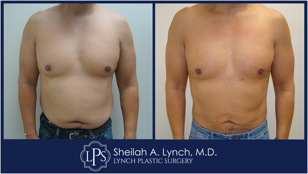Male Lipo 360 Before and After Images In Easton, Chevy Chase, Washington DC.