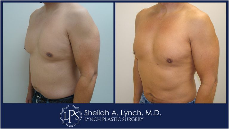 Patient 2 Male Breast Reshaping after weight loss before and after images