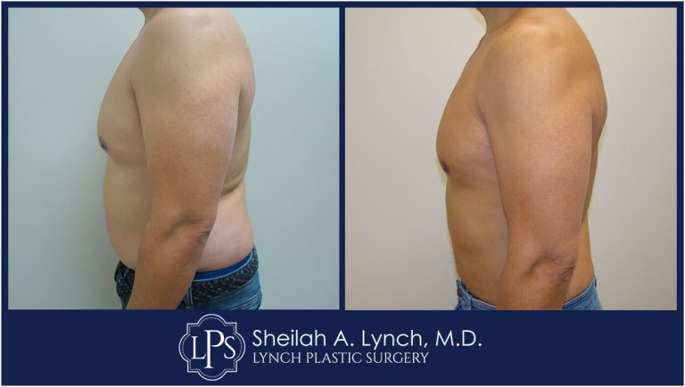 Patient 2 male breast reduction before and after images