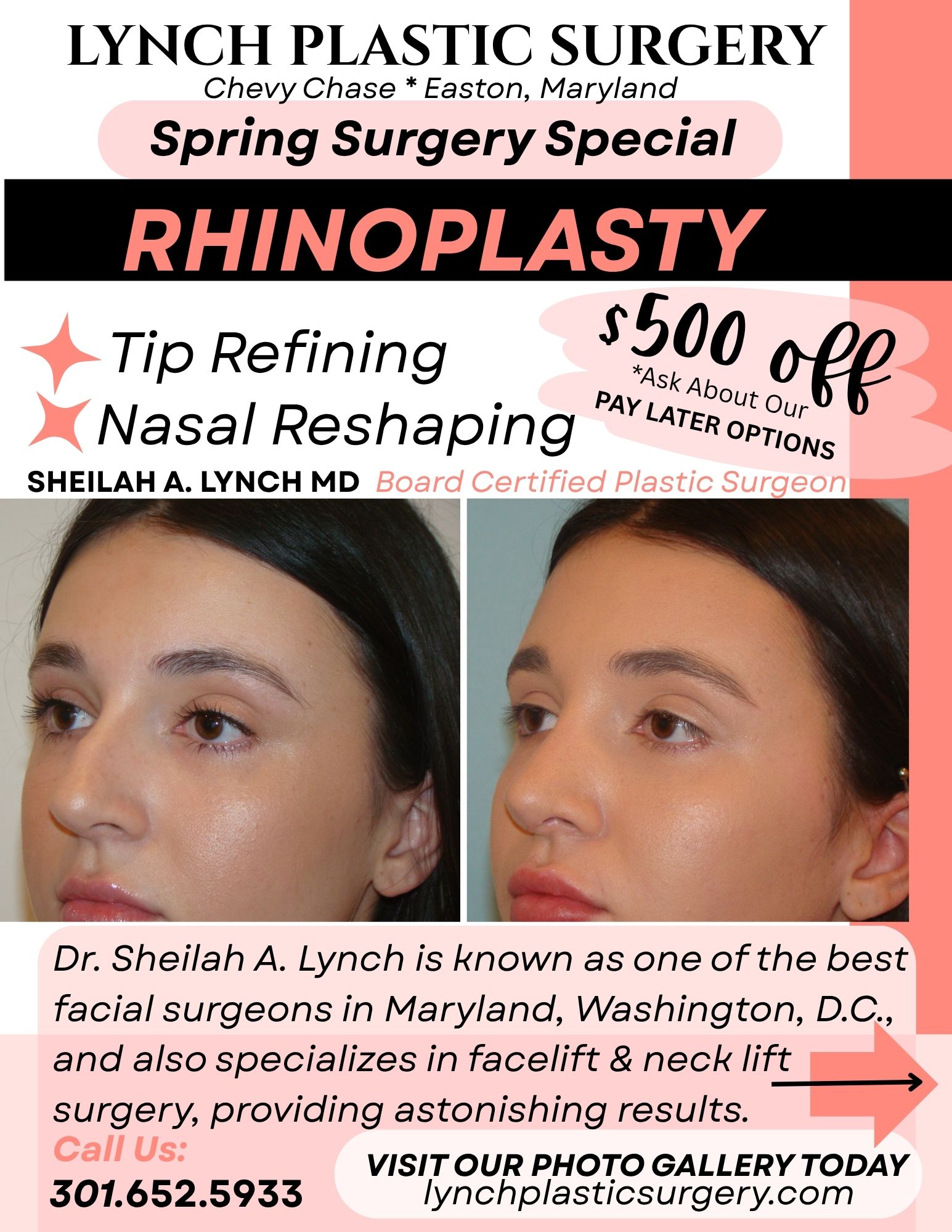 $500 of Rhinoplasty $500 Rhinoplasty Easton rhINOPLASTY sURGERY dISCOUNT