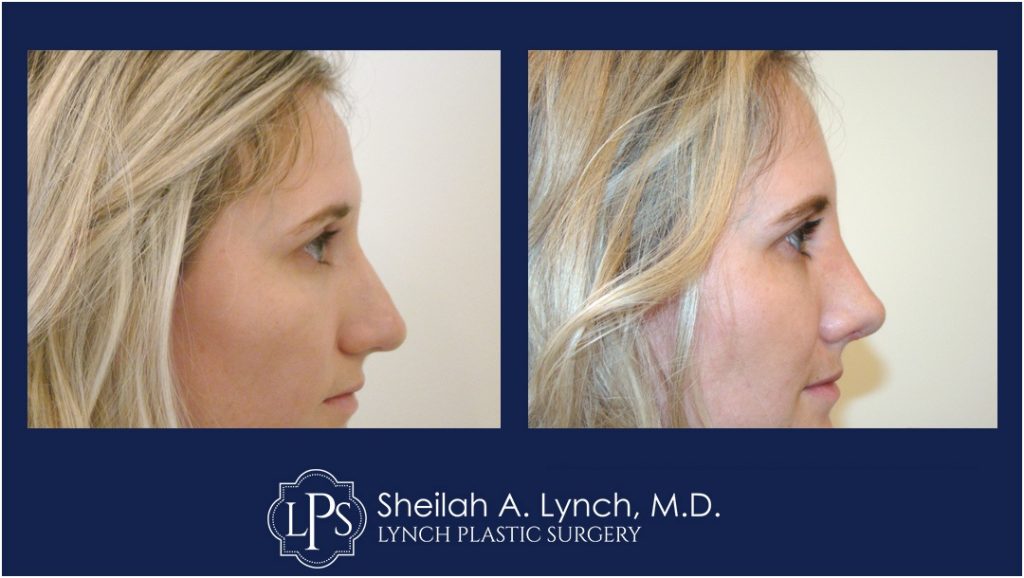 RHINOPLASTY Patient-11