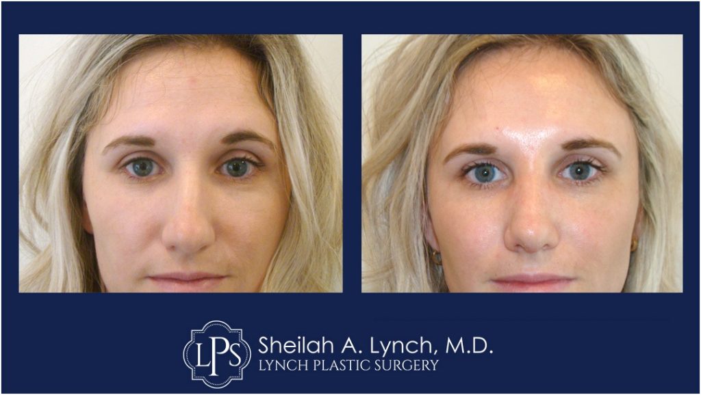 RHINOPLASTY Patient-11