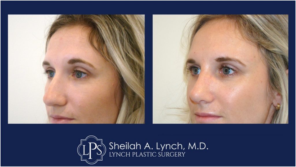 RHINOPLASTY Patient-11