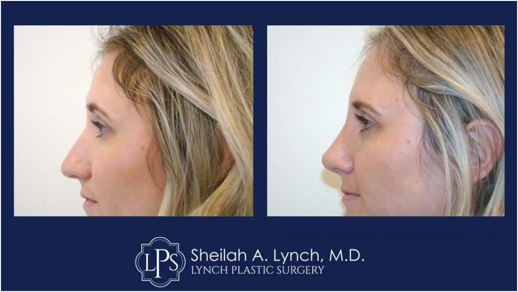 RHINOPLASTY Patient-11