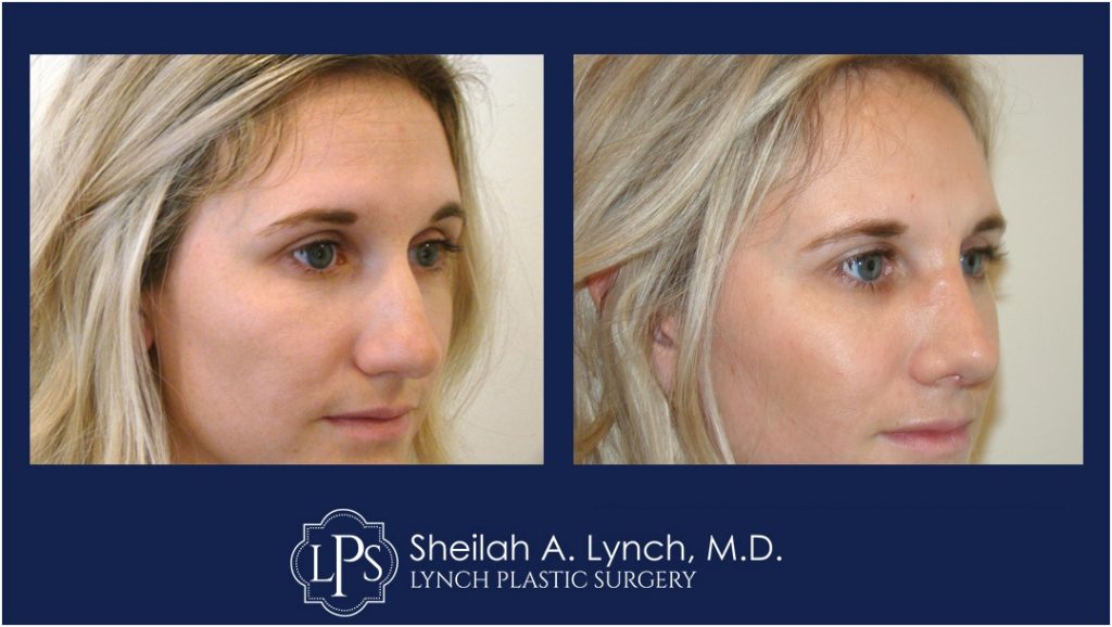 RHINOPLASTY Patient-11