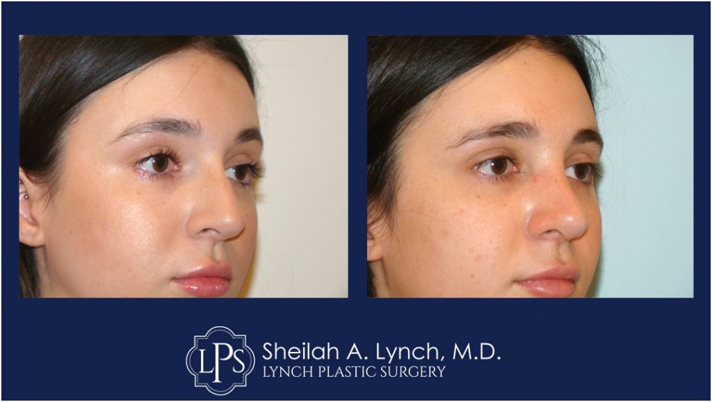 Rhinoplasty Patient 12