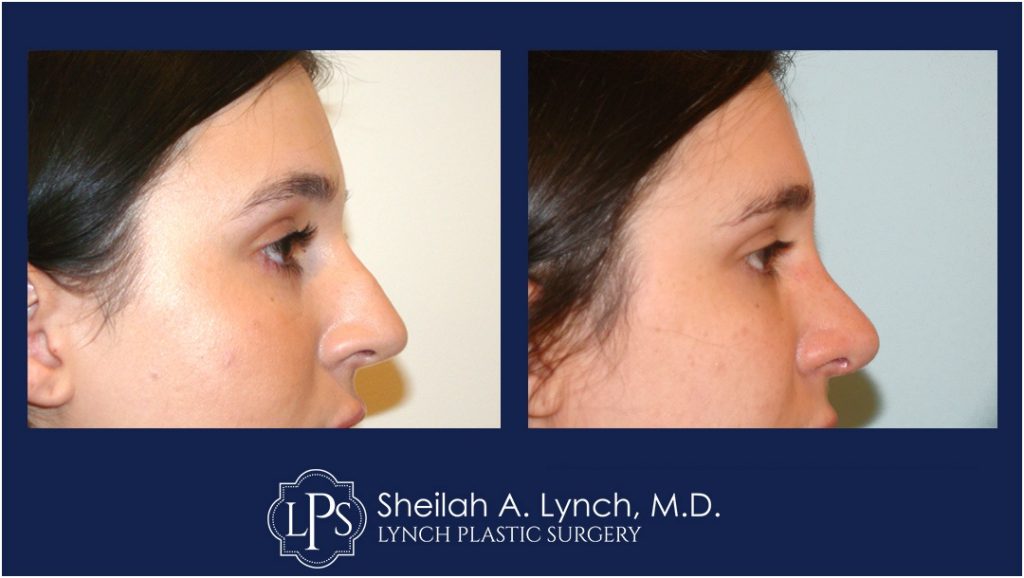 Rhinoplasty Patient 12