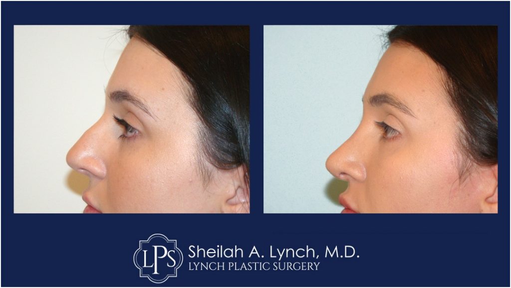 Rhinoplasty Patient 12