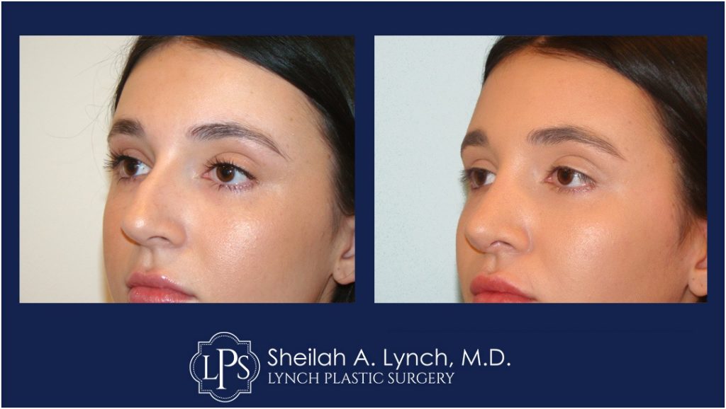 Rhinoplasty Patient 12