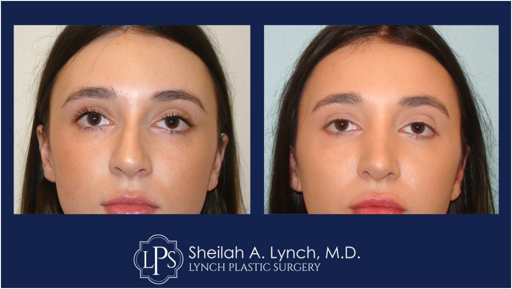 Rhinoplasty Patient 12