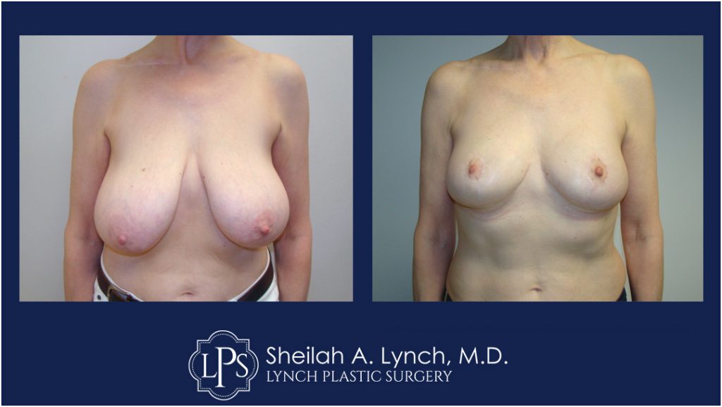 Save $750 off Breast Reduction Surgery - Easton, Maryland - Expert Delaware Breast Reduction Surgeon