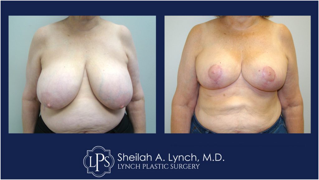 Save $750 off Breast Reduction Surgery - Easton, Maryland - Expert Easton Breast Reduction Surgeon