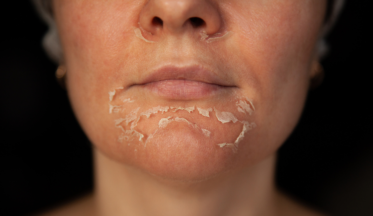 Chemical Peel - TCA 30% Peel Special Easton - Chevy Chase - Washington DC