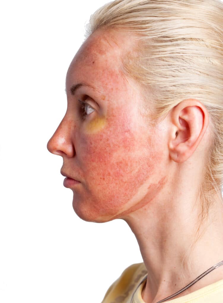 TCA 30% Peel Special Easton - Chevy Chase - Washington DC