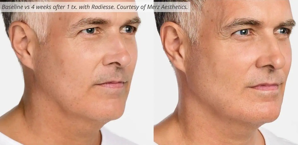 Radiesse Jawline Contouring for men - Facial Balancing for men