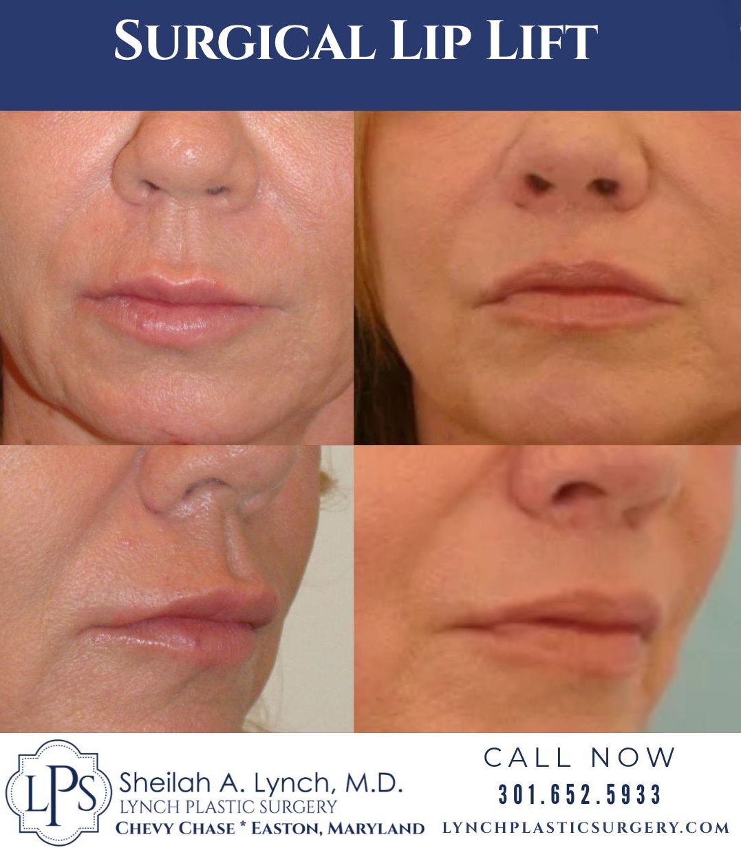 Advanced Lip Lift Surgery Chevy Chase Before and After